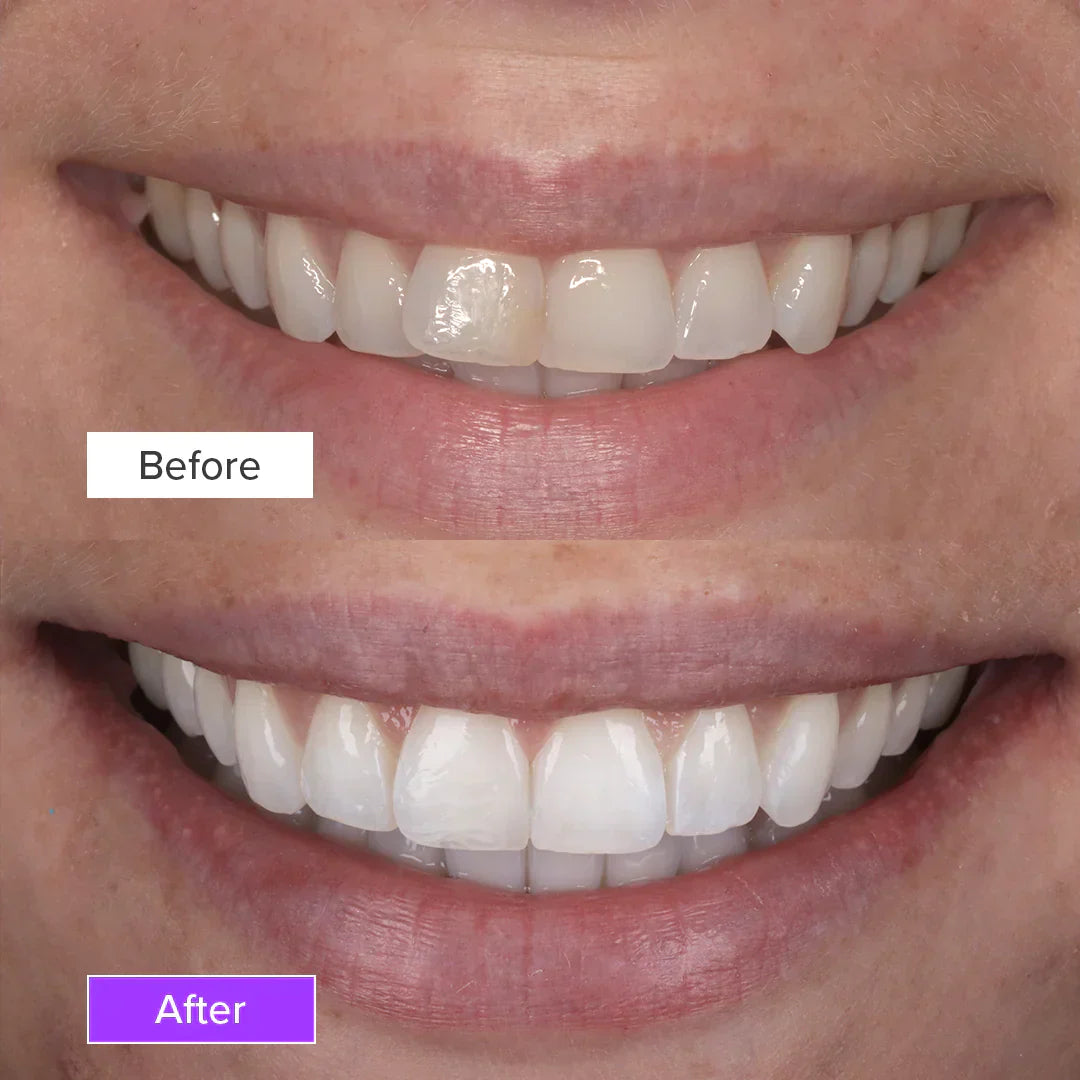 Teeth whitening stripes