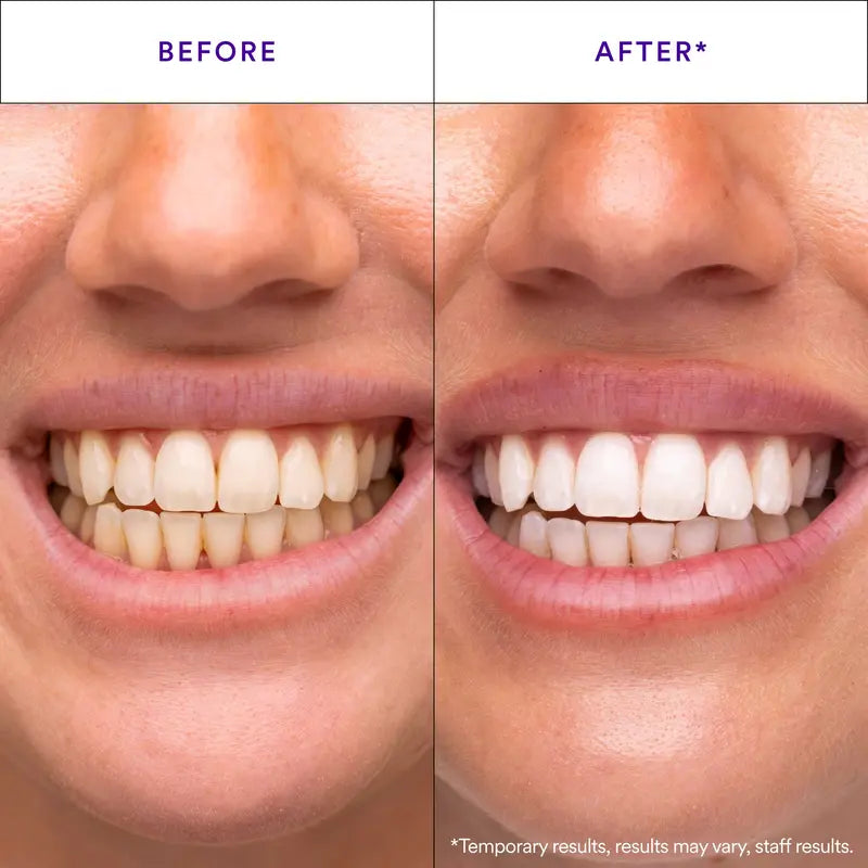 Teeth whitening stripes