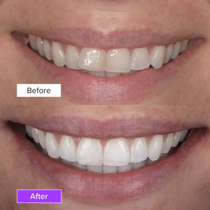 Teeth whitening stripes